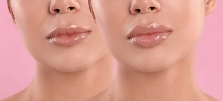 lip implant